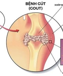 Xét nghiệm chuẩn đoán bệnh gout