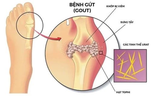 Xét nghiệm chuẩn đoán bệnh gout