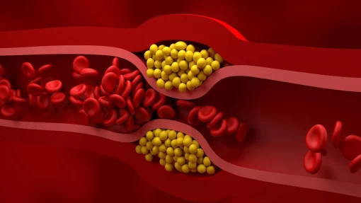 Xét nghiệm LDL- Cholesterol