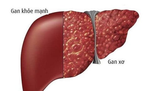 Xét nghiệm chuẩn đoán sơ gan Actitest – Fibrotest