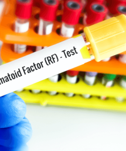Xét nghiệm định lượng RF (Rheumatoid Factor)