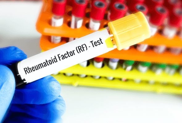 Xét nghiệm định lượng RF (Rheumatoid Factor)