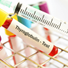 Tầm soát ung thư tuyến giáp Thyroglobulin
