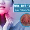 Tầm soát ung thư vòm họng SCC