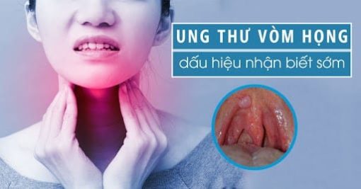 Tầm soát ung thư vòm họng SCC