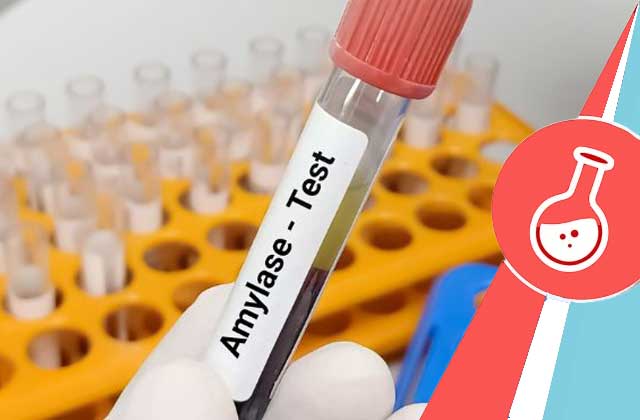 Xét nghiệm Amylase chuẩn đoán bệnh liên quan đến tụy cấp và mãn tính, sỏi mật