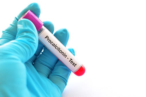 Xét nghiệm Procalcitonin (PCT) máu