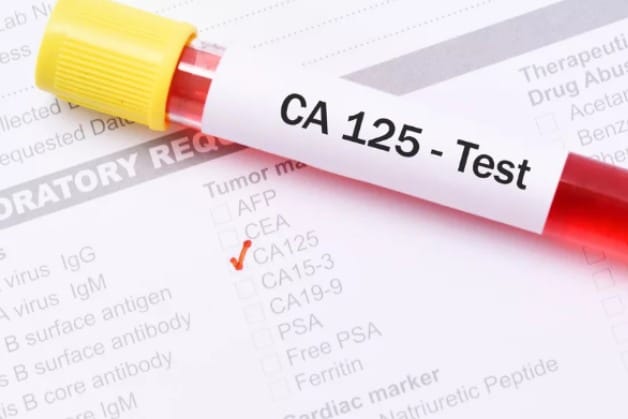 Xét nghiệm tầm soát ung thư buồng trứng CA -125