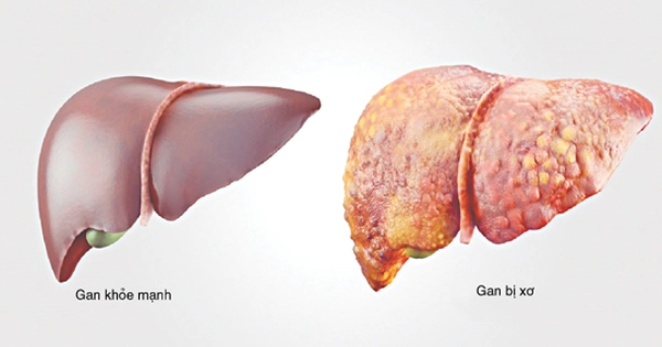 Xét nghiệm tổn thương gan