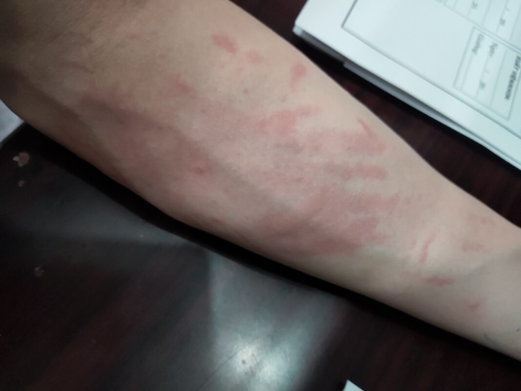 Dấu hiệu nhiễm ký sinh trùng